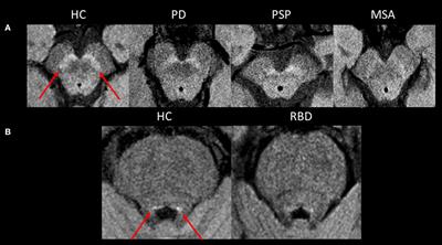 The Role of Magnetic Resonance Imaging for the Diagnosis of Atypical Parkinsonism